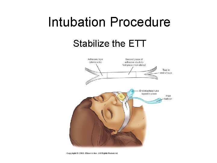Intubation Procedure Stabilize the ETT 
