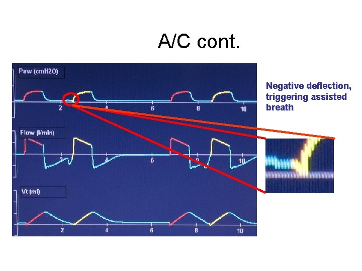 A/C cont. Negative deflection, triggering assisted breath 
