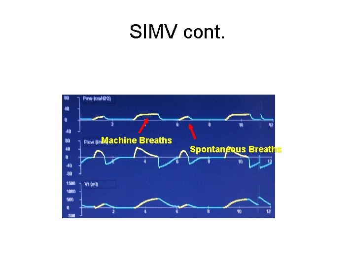 SIMV cont. Machine Breaths Spontaneous Breaths 