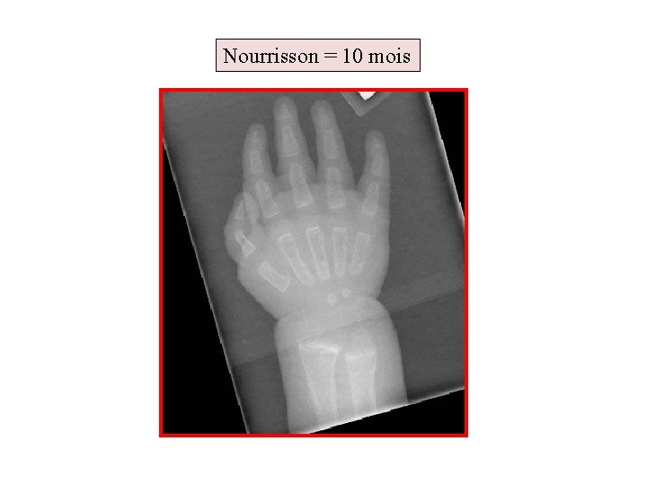 Nourrisson = 10 mois 