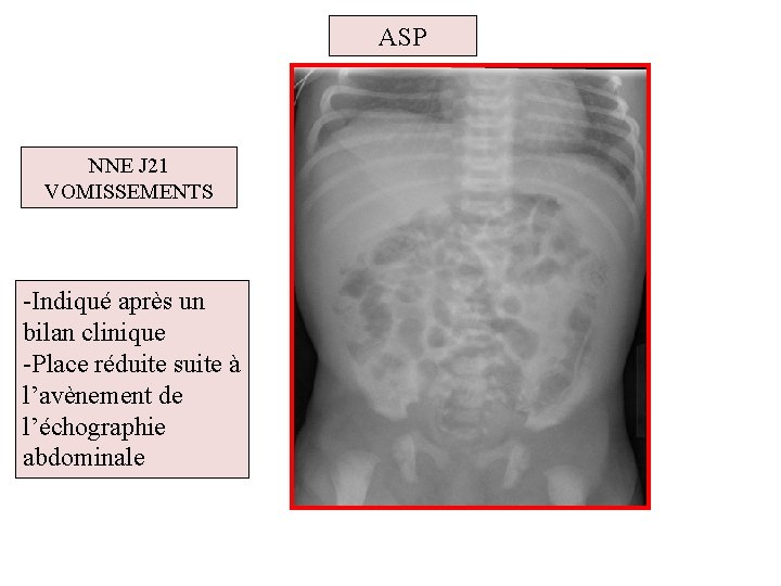 ASP NNE J 21 VOMISSEMENTS -Indiqué après un bilan clinique -Place réduite suite à