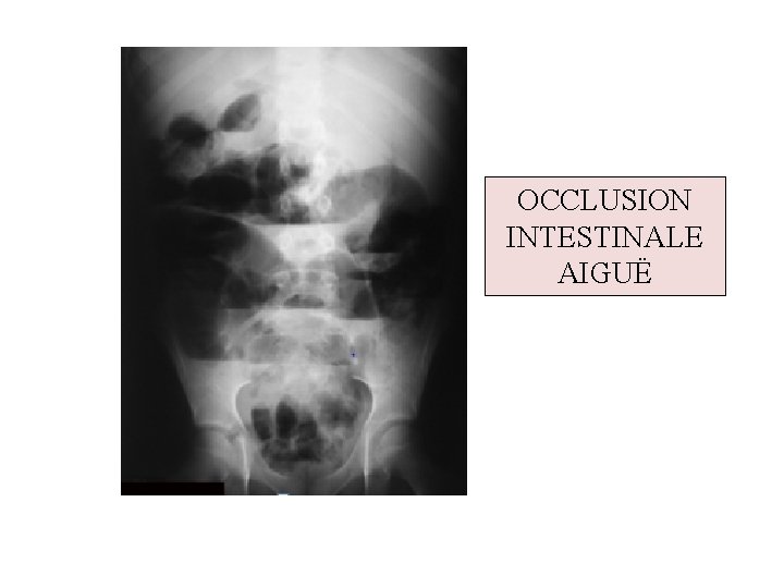 OCCLUSION INTESTINALE AIGUË 