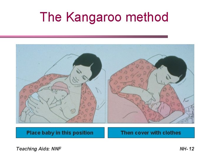 The Kangaroo method Place baby in this position Teaching Aids: NNF Then cover with