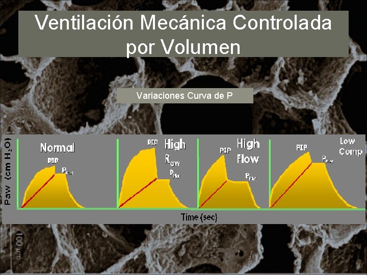 Ventilación Mecánica Controlada por Volumen Variaciones Curva de P 