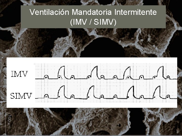 Ventilación Mandatoria Intermitente (IMV / SIMV) 