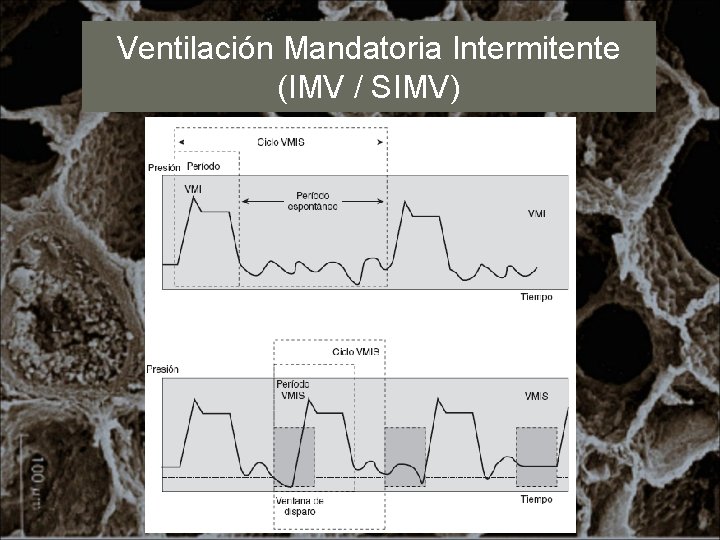 Ventilación Mandatoria Intermitente (IMV / SIMV) 