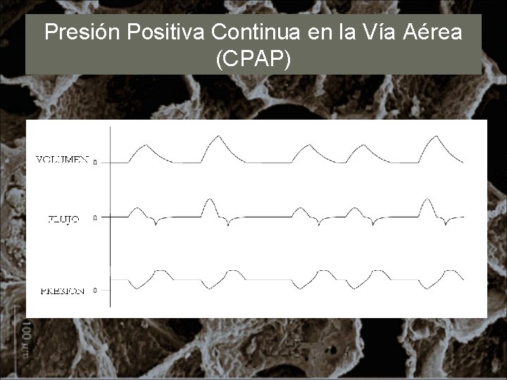 Presión Positiva Continua en la Vía Aérea (CPAP) 