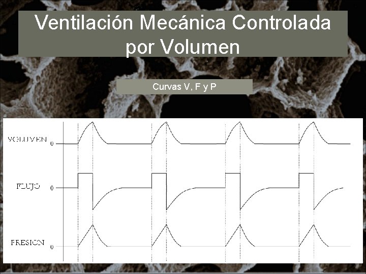 Ventilación Mecánica Controlada por Volumen Curvas V, F y P 