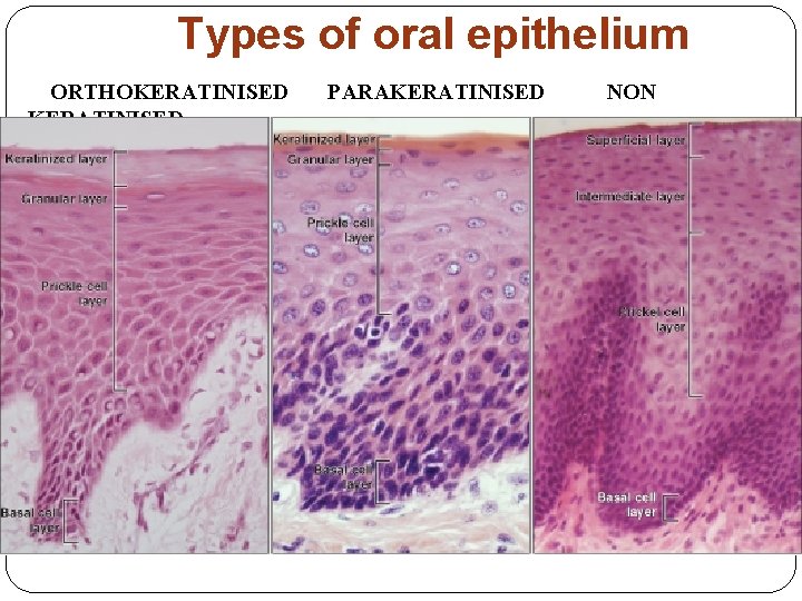 Types of oral epithelium ORTHOKERATINISED PARAKERATINISED NON KERATINISED 