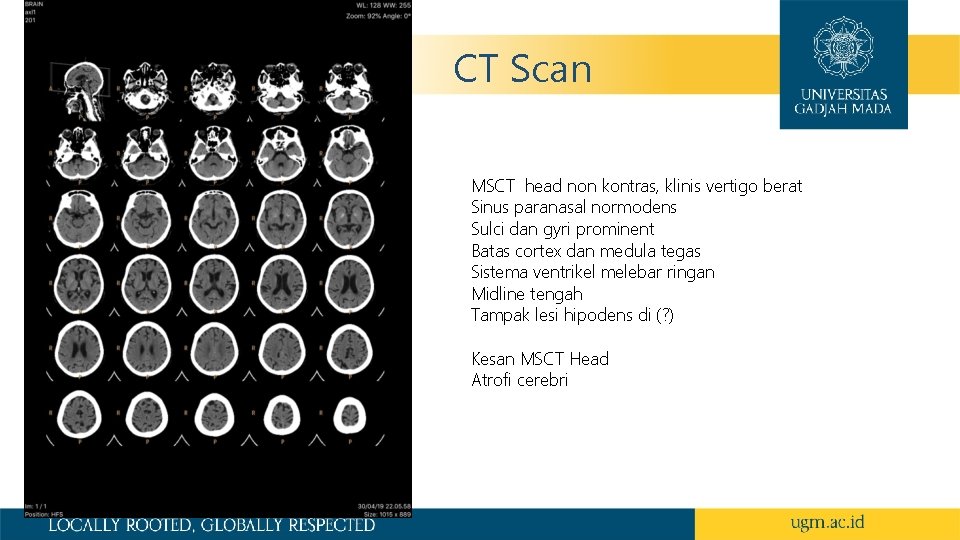 CT Scan MSCT head non kontras, klinis vertigo berat Sinus paranasal normodens Sulci dan