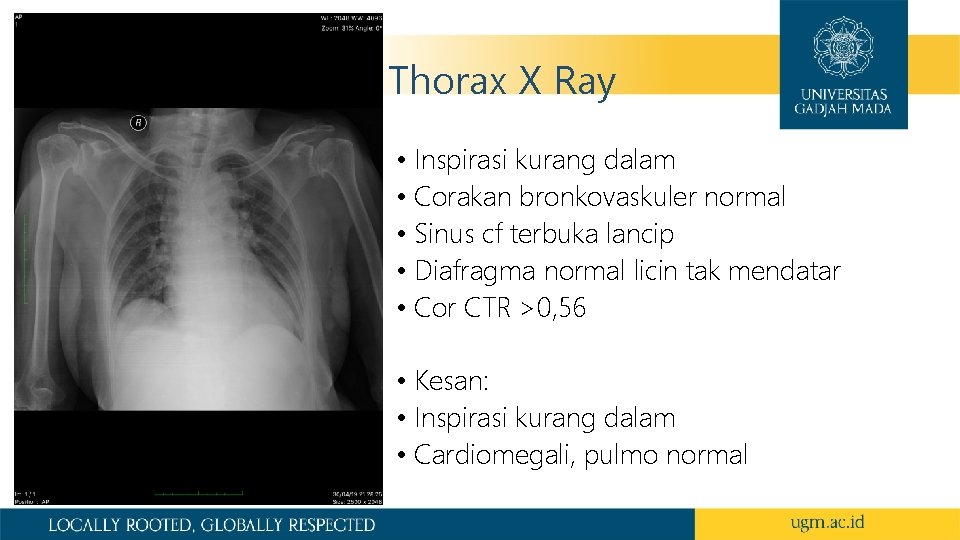 Thorax X Ray • Inspirasi kurang dalam • Corakan bronkovaskuler normal • Sinus cf
