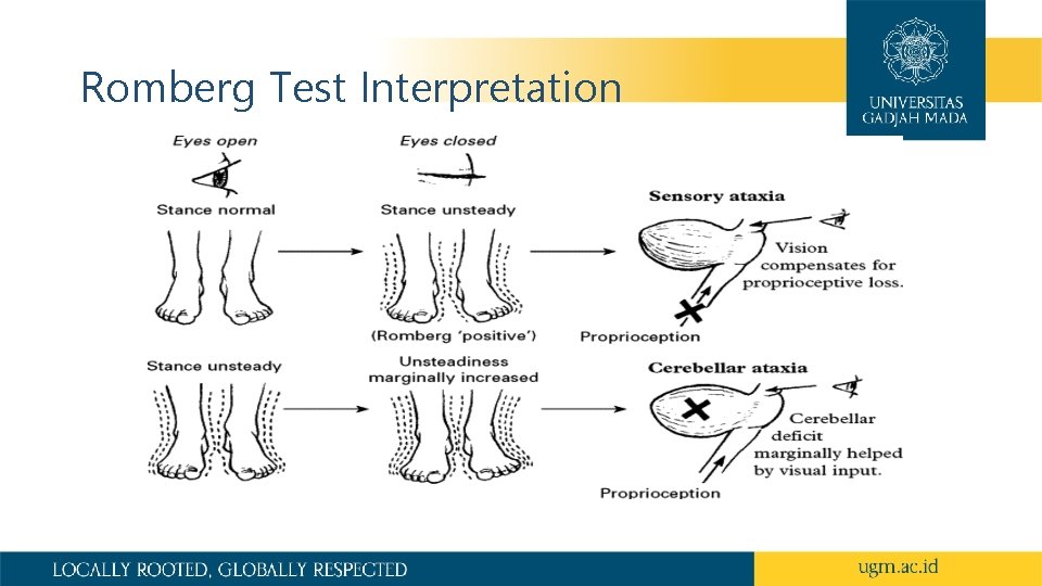 Romberg Test Interpretation 