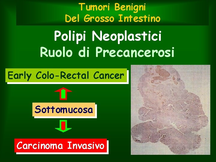 Tumori Benigni Del Grosso Intestino Polipi Neoplastici Ruolo di Precancerosi Early Colo-Rectal Cancer Sottomucosa