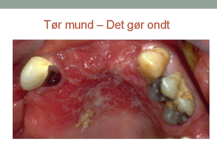 Tør mund – Det gør ondt 