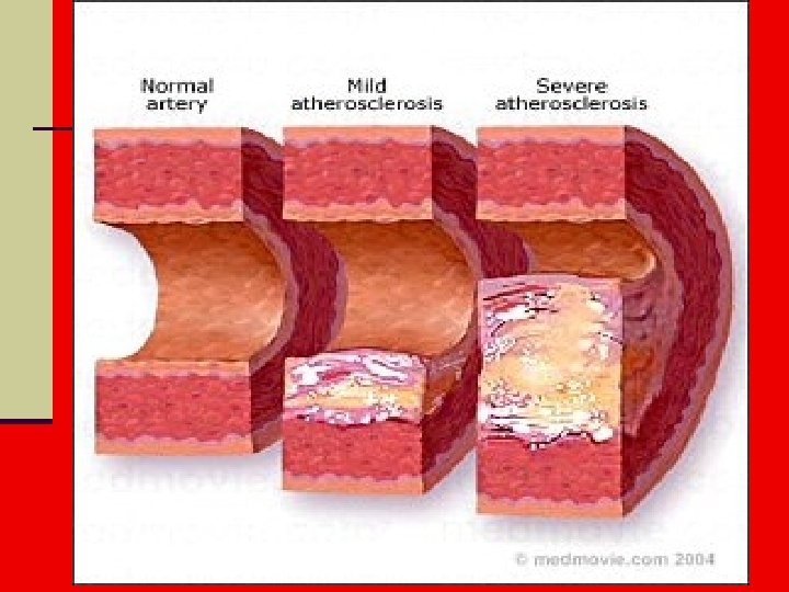 Disorders of Circulatory System n Atherosclerosis- (hardening of the arteries) excess cholesterol and fat