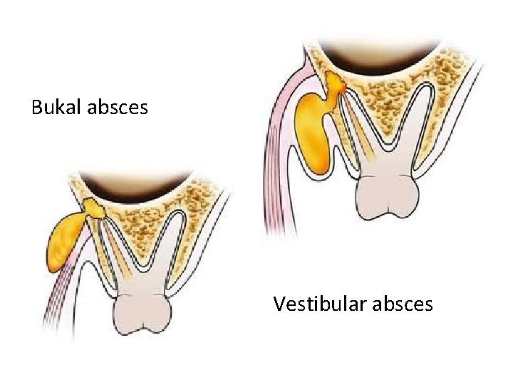 Bukal absces Vestibular absces 