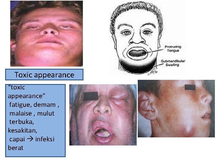 Toxic appearance “toxic appearance” fatigue, demam , malaise , mulut terbuka, kesakitan, capai infeksi