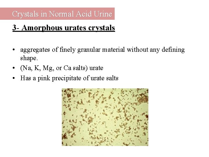 Crystals in Normal Acid Urine 3 - Amorphous urates crystals • aggregates of finely
