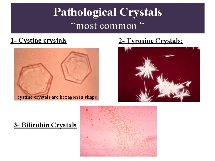 Pathological Crystals “most common “ 1 - Cystine crystals cystine crystals are hexagon in