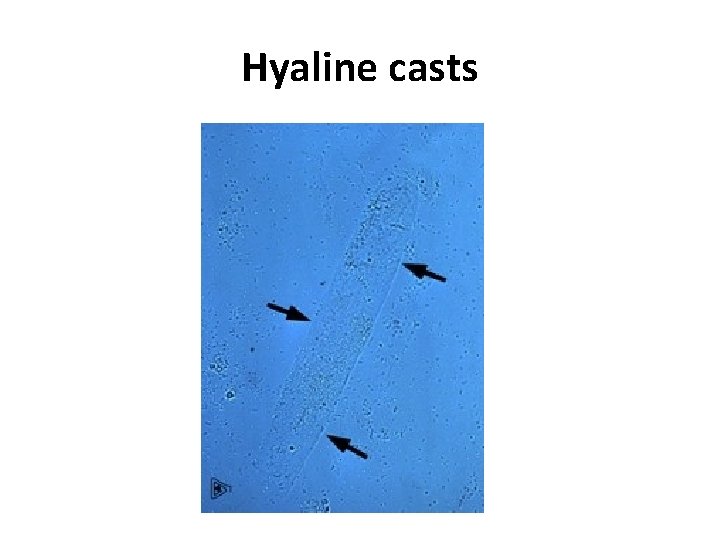 Hyaline casts 