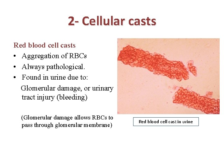 2 - Cellular casts Red blood cell casts • Aggregation of RBCs • Always
