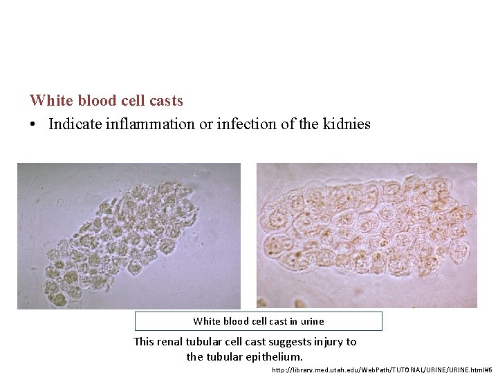 White blood cell casts • Indicate inflammation or infection of the kidnies White blood