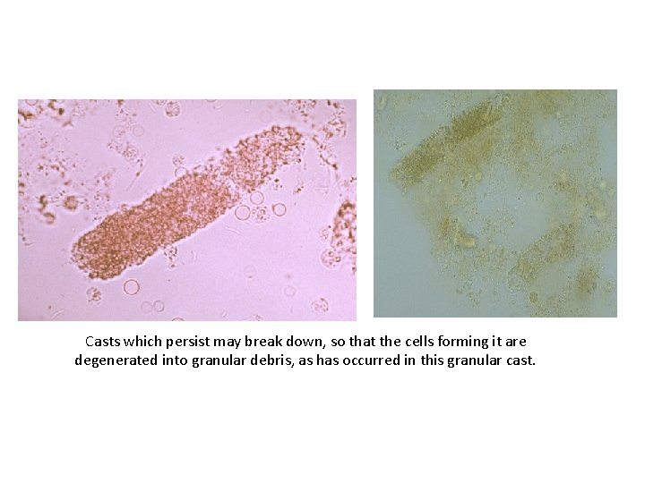 Casts which persist may break down, so that the cells forming it are degenerated