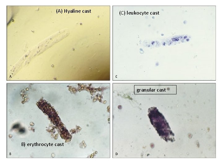 (A) Hyaline cast (C) leukocyte cast granular cast B) erythrocyte cast 