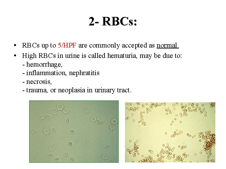 2 - RBCs: • RBCs up to 5/HPF are commonly accepted as normal. •