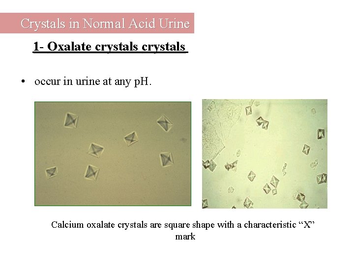 Crystals in Normal Acid Urine 1 - Oxalate crystals • occur in urine at