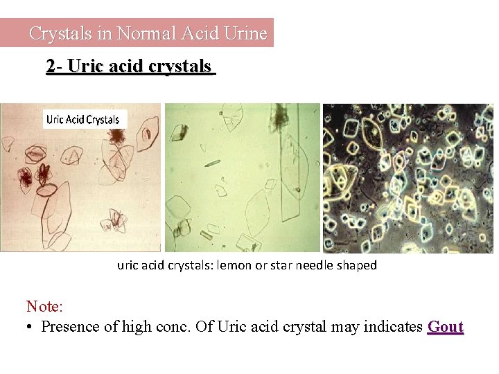 Crystals in Normal Acid Urine 2 - Uric acid crystals uric acid crystals: lemon