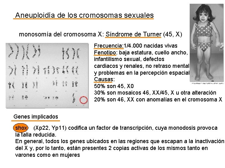 Aneuploidía de los cromosomas sexuales monosomía del cromosoma X: Síndrome de Turner (45, X)