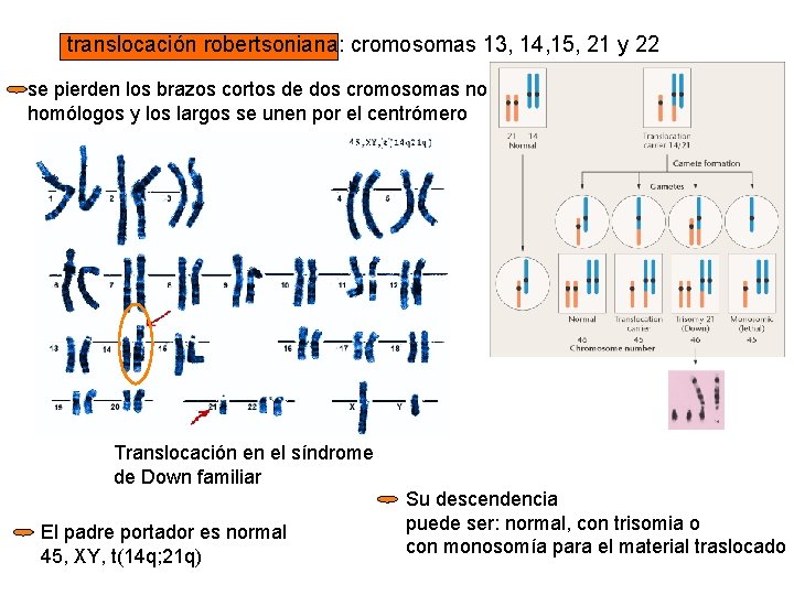 translocación robertsoniana: cromosomas 13, 14, 15, 21 y 22 se pierden los brazos cortos