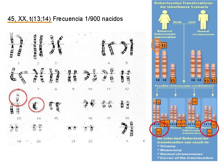 45, XX, t(13; 14) Frecuencia 1/900 nacidos 13 13 13 13 