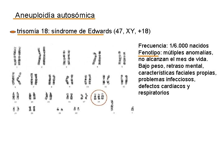 Aneuploidía autosómica trisomía 18: síndrome de Edwards (47, XY, +18) Frecuencia: 1/6. 000 nacidos