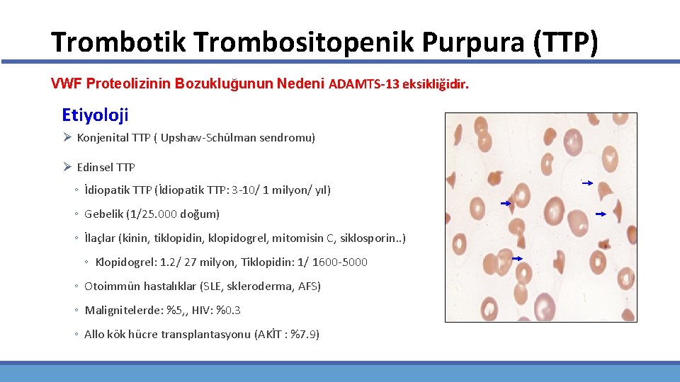 Trombotik Trombositopenik Purpura (TTP) VWF Proteolizinin Bozukluğunun Nedeni ADAMTS-13 eksikliğidir. Etiyoloji Ø Konjenital TTP