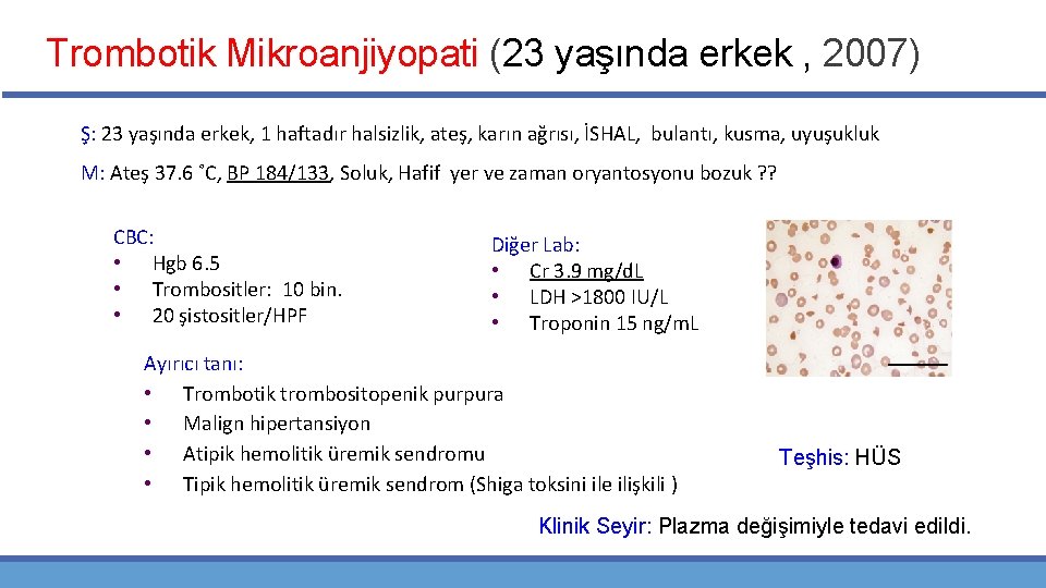 Trombotik Mikroanjiyopati (23 yaşında erkek , 2007) Ş: 23 yaşında erkek, 1 haftadır halsizlik,