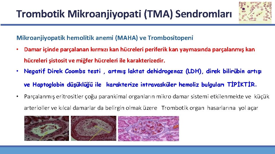 Trombotik Mikroanjiyopati (TMA) Sendromları Mikroanjiyopatik hemolitik anemi (MAHA) ve Trombositopeni • Damar içinde parçalanan