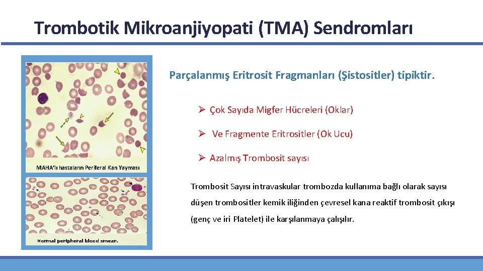 Trombotik Mikroanjiyopati (TMA) Sendromları Parçalanmış Eritrosit Fragmanları (Şistositler) tipiktir. • Tipiktir Ø Çok Sayıda