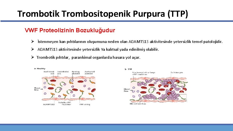 Trombotik Trombositopenik Purpura (TTP) VWF Proteolizinin Bozukluğudur Ø İstenmeyen kan pıhtılarının oluşumuna neden olan