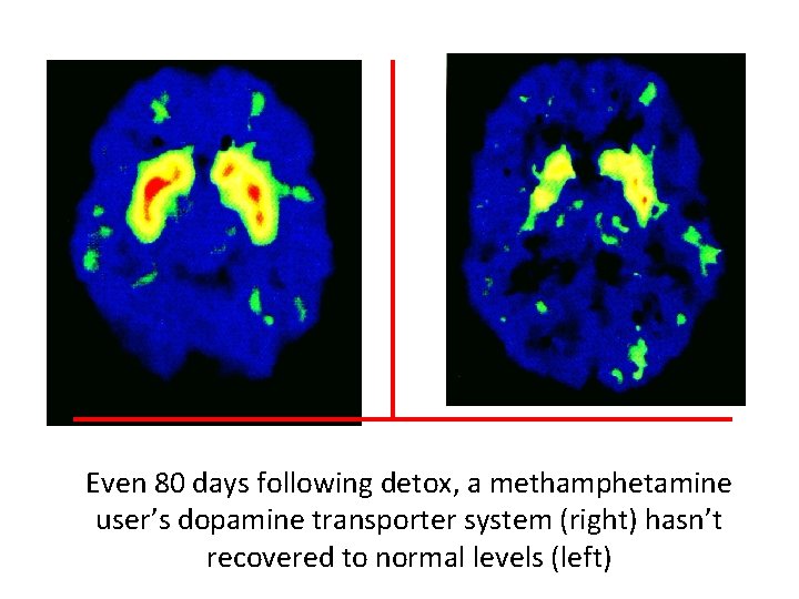 Even 80 days following detox, a methamphetamine user’s dopamine transporter system (right) hasn’t recovered