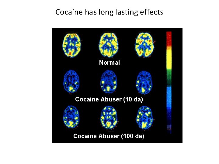 Cocaine has long lasting effects Normal Cocaine Abuser (10 da) Cocaine Abuser (100 da)