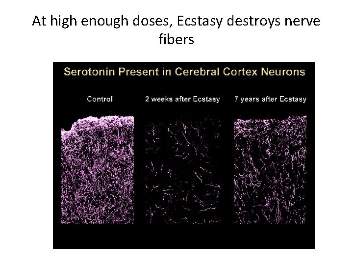 At high enough doses, Ecstasy destroys nerve fibers 