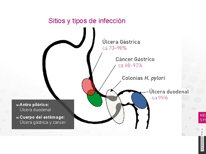 Sitios y tipos de infección Antro pilórico: Úlcera duodenal Cuerpo del estómago: Úlcera gástrica