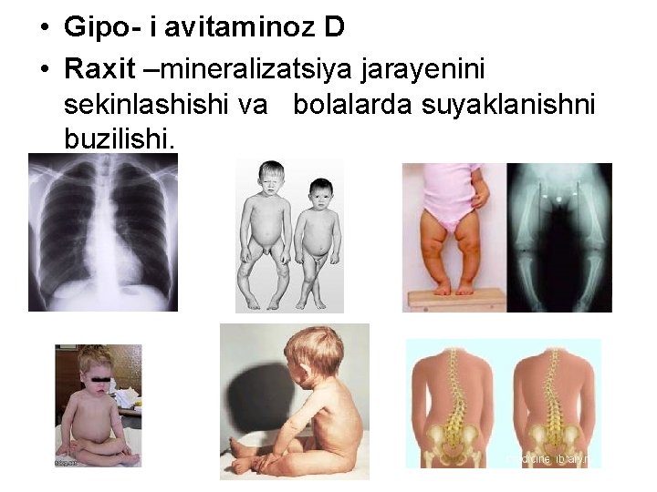  • Gipo- i avitaminoz D • Raxit –mineralizatsiya jarayenini sekinlashishi va bolalarda suyaklanishni