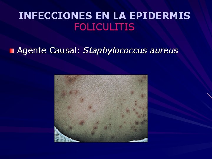 INFECCIONES EN LA EPIDERMIS FOLICULITIS Agente Causal: Staphylococcus aureus 