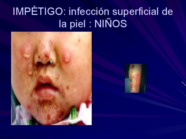 IMPÈTIGO: infección superficial de la piel : NIÑOS 