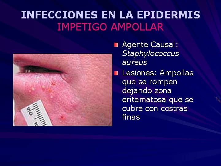 INFECCIONES EN LA EPIDERMIS IMPETIGO AMPOLLAR Agente Causal: Staphylococcus aureus Lesiones: Ampollas que se