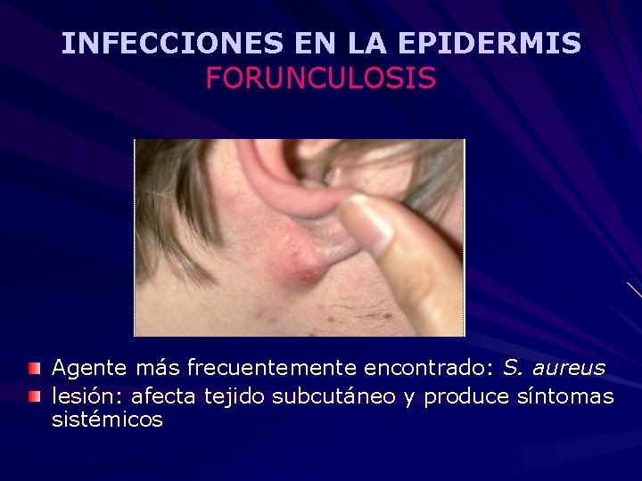 INFECCIONES EN LA EPIDERMIS FORUNCULOSIS Agente más frecuentemente encontrado: S. aureus lesión: afecta tejido
