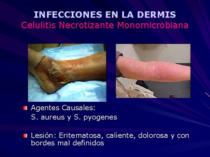 INFECCIONES EN LA DERMIS Celulitis Necrotizante Monomicrobiana Agentes Causales: S. aureus y S. pyogenes